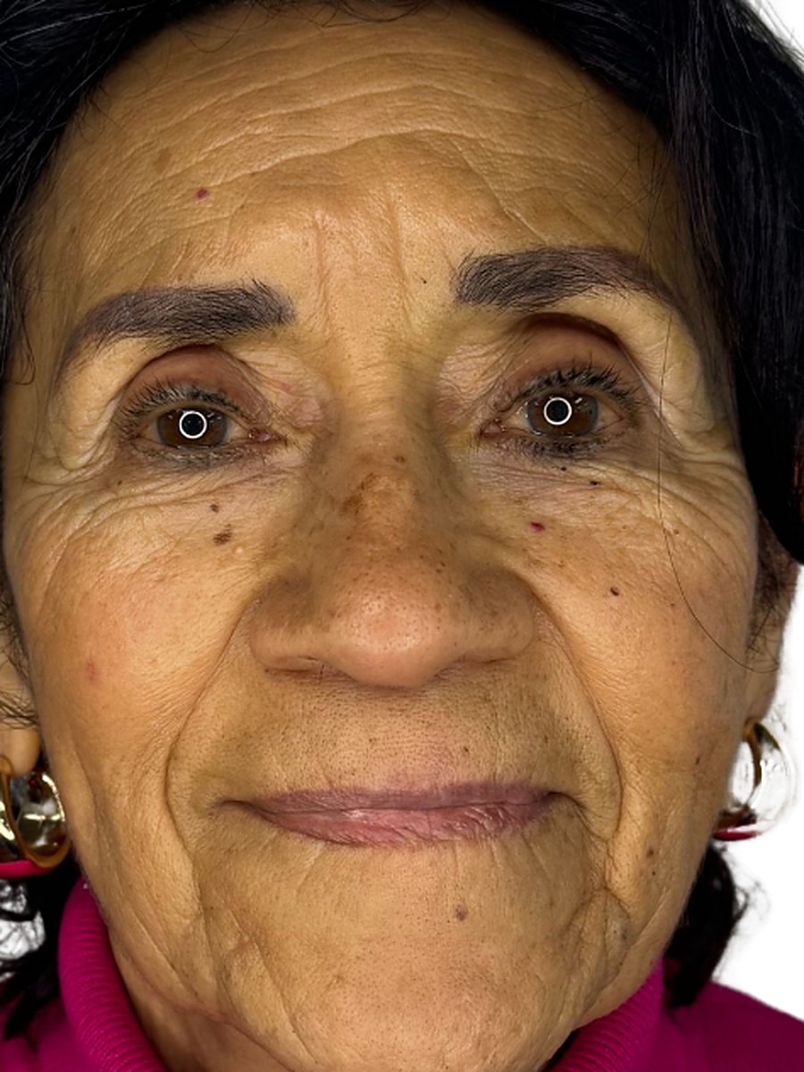 Antes: Profhilo: bioremodelación de la piel
