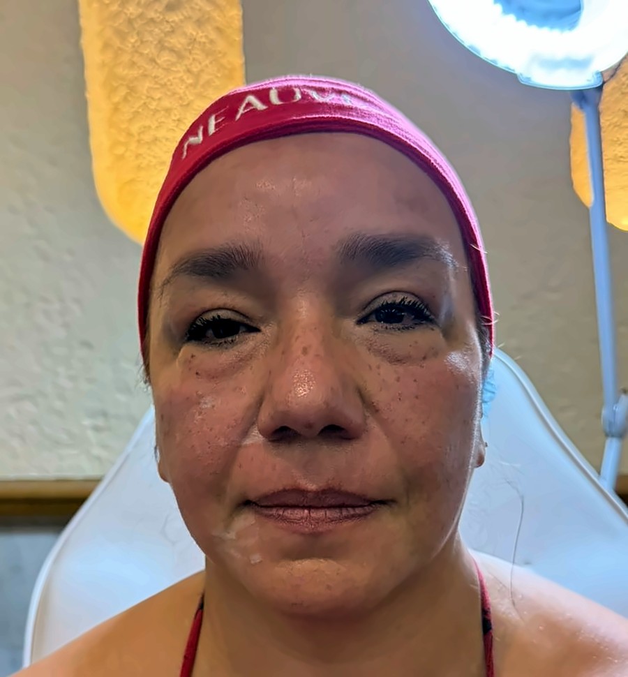 Antes: Skinbooster y levantamiento del tercio medio con ácido hialurónico
